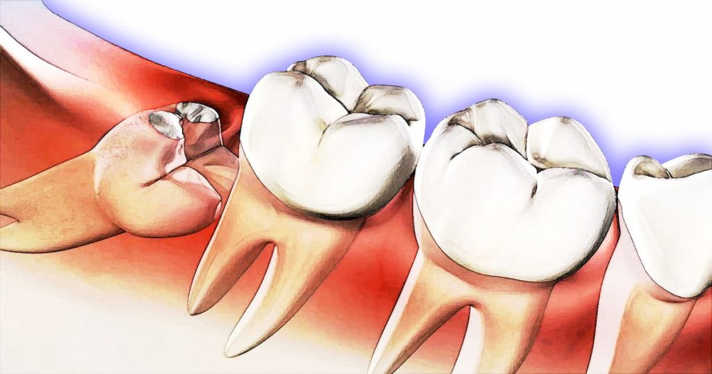 Wisdom Teeth Removal Reasons